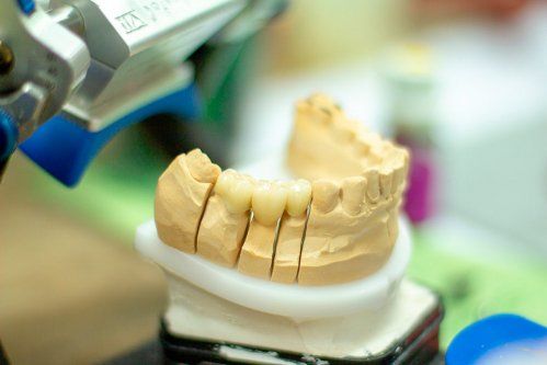 Prótesis dentales en Segovia