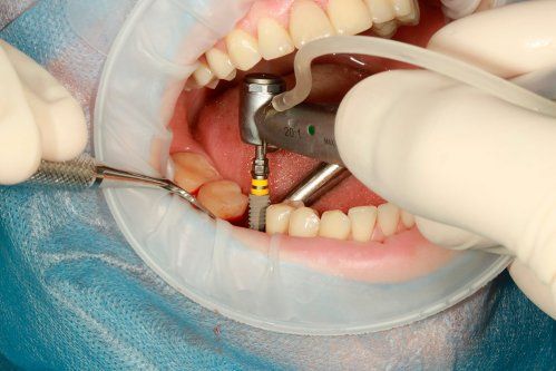 Implantes dentales en Segovia